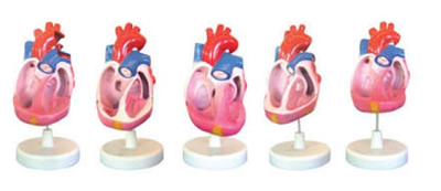 先天性心脏畸形模型（5部件）