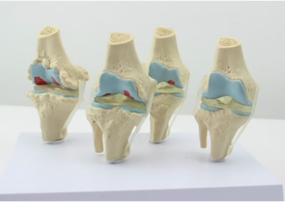 SYL/053 四阶段膝关节模型