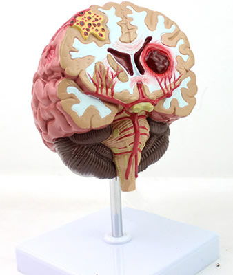 脑部病症演示模型