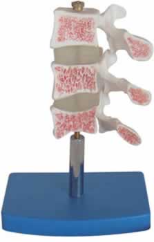 骨质疏松症模型