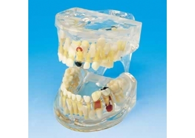 透明乳牙病理模型