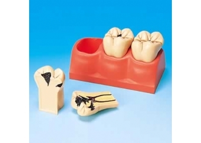 龋齿分解剖模型