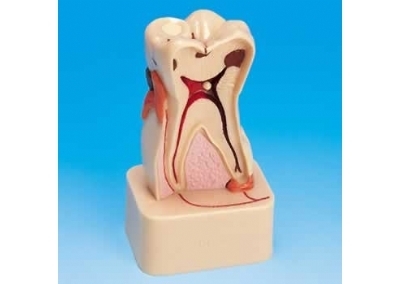 牙齿病变综合病理分解模型