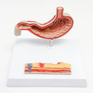 病理胃模型