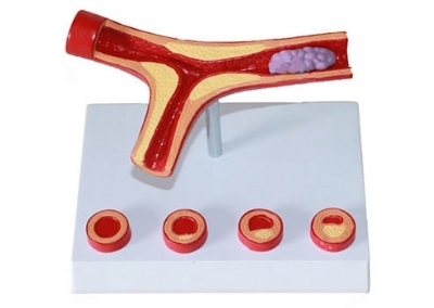 SYL/2082 动脉硬化带血栓模型