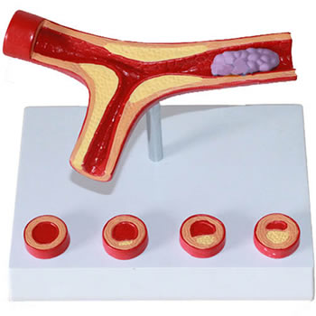 动脉硬化带血栓模型